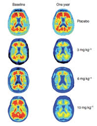 The safety and tolerability of aducanumab was the primary aim of the study. Paper Alert Aducanumab Phase 1b Study Published Alzforum