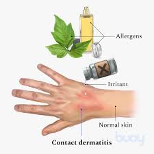Image result for dermatitis contacta toxica