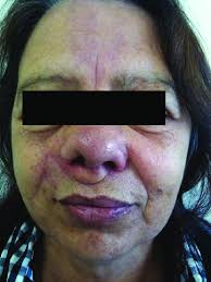 Postoperative results of nasal reconstruction based