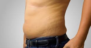 Cara ampuh mengatasi stretch mark yang sulit hilang. Stretch Mark Pada Pria Apa Penyebabnya Hello Sehat