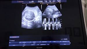 Gambar yang dihasilkan saat pemeriksaan ultrasound 3d umumnya diambil pada berbagai sudut dan kemudian disatukan untuk membentuk rendering tiga dimensi. Usg Bayi Perempuan Dalam Kandungan Usia 6 Bulan Youtube