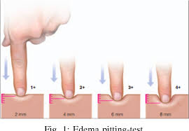 Image result for Edema Exam