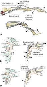 Image result for Elson Extensor Tendon Test