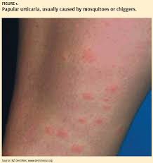 Image result for Papular urticaria