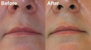 Smaller areas, such as the upper lip, can take just minutes. Preparing For A Successful Upper Lip Laser Hair Removal Procedure Albanian Journalism