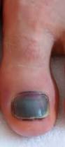 Image result for toe black diabetes