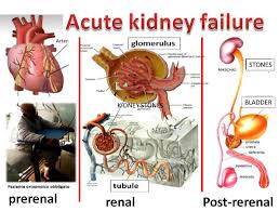 Image result for Postrenal Failure