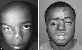 The surgical repair of half-nose