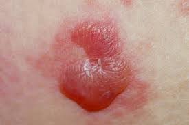 Image result for Pemphigoid