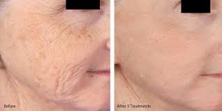 Aesthetics Microneedling Skin Tightening Wrinkles