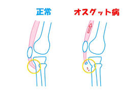 オスグッド・シュラッター病を治す＞長野県須坂市森上鍼灸整骨院