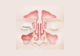 Nasal polyps are a subgroup of chronic rhinosinusitis. Nasal Polyps Gno Snoring Sinus