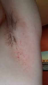 Was Ist Das An Meinen Achseln Seit 7 Tage Gesundheit Und Medizin Gesundheit Pilzinfektion