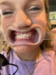 Today was an unexpected day. We visited the Ortho, for what we thought was  a routine check up. While there they realized that the braces had over  corrected in some spots (back