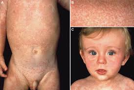 Sporadic Blau Syndrome With Onset of Widespread Granulomatous Dermatitis in  the Newborn Period