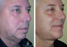 Webmd shows you the more popular plastic surgery choices many make, including hair transplants and microdermabrasion. Cosmetic Surgery For Men In Bangkok Doctor Reviews Prices Pictures Aesthetic Surgery Center Of Thailand
