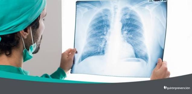 Cáncer de pulmón de origen laboral
