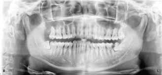 Had one chipped and went ahead and got both bottom done. Milford Dentists Wisdom Teeth