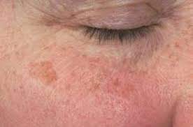 Facial Blemishes Skin Blemishes Skin Conditions Blemishes