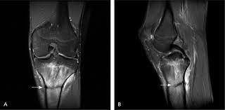 Image result for Tibia Stress Fracture