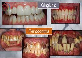 Gum Disease And Gingivitis