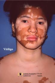 Image result for Vitiligo