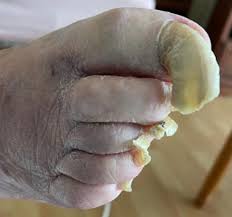 Image result for Onychogryphosis feet