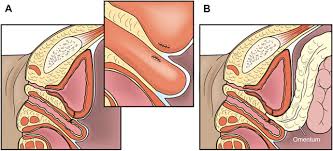 Make it the best it can be with from modern and formal spaces to approachable and rustic environments, there's a living room idea you'll rather than opting for all black and whites, the anchor pieces—like sofa and tables—remain. Epiploic Appendix An Overview Sciencedirect Topics