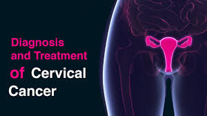 Chemo (by itself) is often used to treat advanced cervical cancer. Cervical Cancer Diagnosis And Assessment Gtak Health
