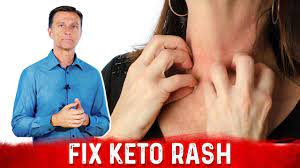 Keto Rash Is A Vitamin B2 Riboflavin Deficiency Youtube Keto Rash Keto Vitamins For Skin