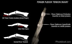 It commonly occurs when an athlete's finger catches in another player's jersey, usually while playing a tackling sport such as rugby or american football. Flexor Tendon Injury At The Dip Joint