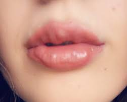 Skin ethics now offer a new and innovative way of plumping the lips using this technique, three types of treatment can be done: Mum 20 Horrified After 85 No Needle Lip Filler She Bought Over Facebook Left Her Lips Lumpy And Bruised