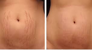 Stretch marks can be pink, red, brown, black, silver or purple. Does Skin Needling Work On Stretch Marks