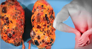 8 Bad Habits Are Damaging Your Kidneys Every Day Immediately Curb These Water Retention Bad Habits Water Retention Remedies