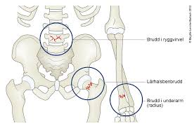 • høydetap på 4 cm kan være indikasjon på osteoporose • holdningsforandringer. Brudd I Ryggsoylen Til Eldre Nhi No