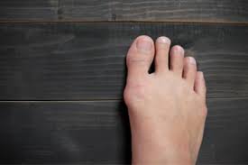 Hallux Valgus Was Ist Das Was Kann Man Dagegen Tun Breitefuesse De