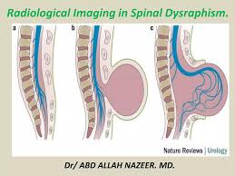 Image result for Dysraphism