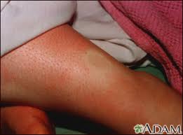 Image result for Tropical Edema