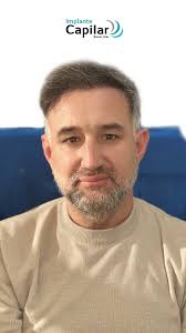 LA CALVICIE ES COSA DEL PASADO! , Nuestro paciente Ramiro Cabrera a 6 meses  de su implante capilar ya está viendo grandes y notorios resultados! ,  Conoce su experiencia con nosotros!, No esperés más ...