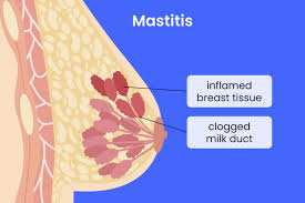 Image result for Mastitis