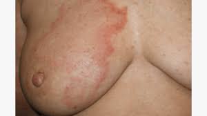 Are Hives on the Breast a Symptom of Another Health Condition?