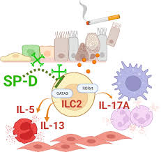 IL-17A+ group 2 innate lymphoid cells elicit mixed airway inflammation in  chronic obstructive pulmonary disease