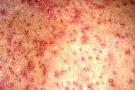 Image result for sweat rash on back baby
