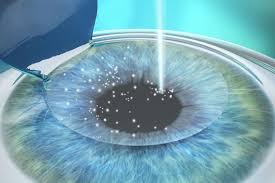 11 taman jaya, jln kulim, 14000 bukit mertajam. Lasik Singapore Best 10 Recommended Lasik Clinics In Singapore Price And Reviews 2021