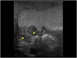 Normal Fluid Passage Through The Pyloric Channel
