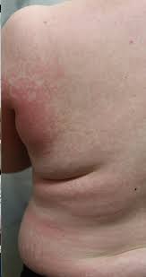 Image result for Mastitis