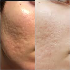 Maybe you would like to learn more about one of these? B A 25f A Year Ago Vs Now Acne Scar Progress On My Worst Patch Of Scarring Skincareaddiction