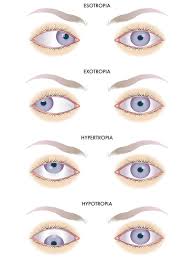 Image result for Strabismus