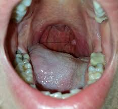 The cause of the tightness can vary from an infection like strep throat to a more serious allergic. Is This Throat Cancer Images Cancer Forums Patient