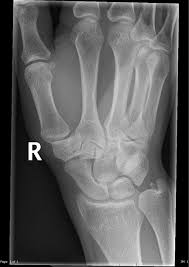 Os Triangulare Radiology Case Radiopaedia Org Radiology Pediatric Radiology Radiography